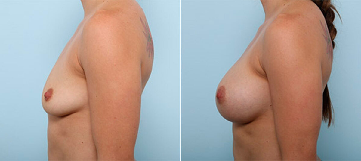 Breast Augmentation before and after photos in Houston, TX, Patient 26383