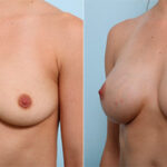 Breast Augmentation before and after photos in Houston, TX, Patient 26383