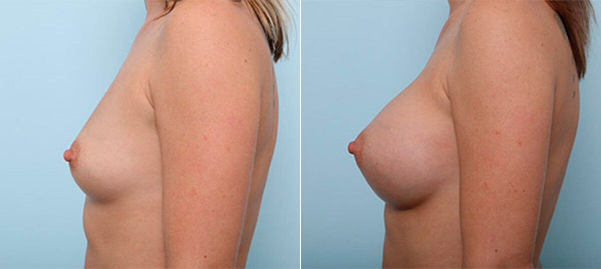 Breast Augmentation before and after photos in Houston, TX, Patient 26394
