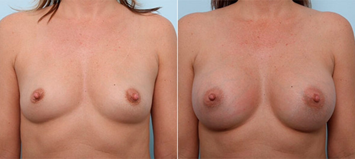 Breast Augmentation before and after photos in Houston, TX, Patient 26394