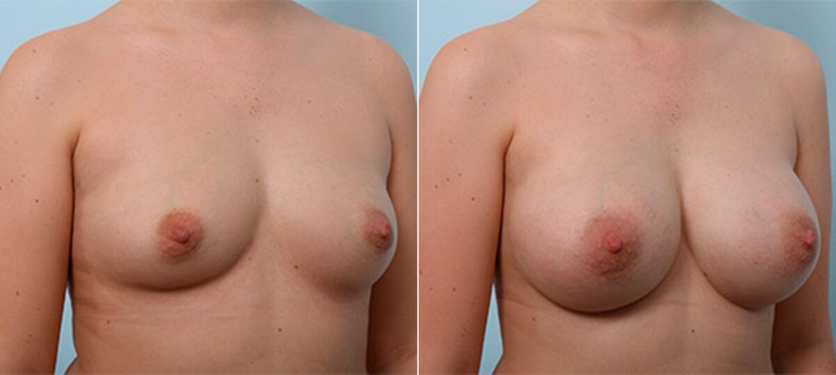 Breast Augmentation before and after photos in Houston, TX, Patient 26405