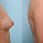 Breast Augmentation before and after photos in Houston, TX, Patient 26405