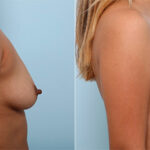 Breast Augmentation before and after photos in Houston, TX, Patient 26416