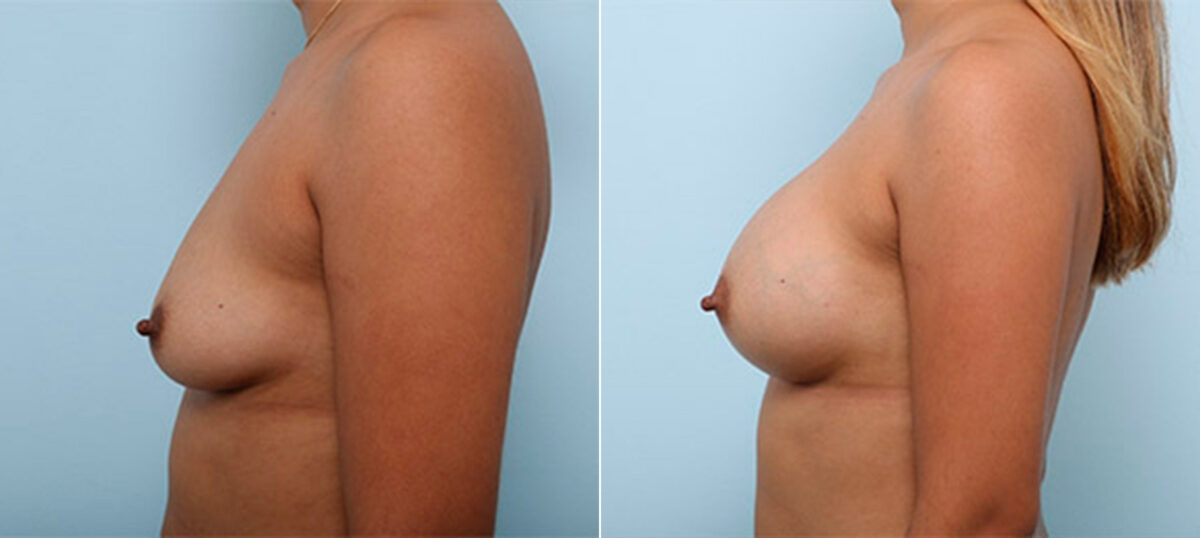 Breast Augmentation before and after photos in Houston, TX, Patient 26416