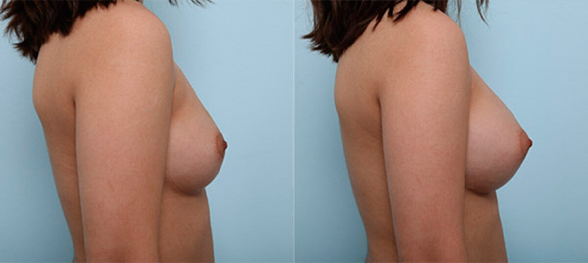 Breast Augmentation before and after photos in Houston, TX, Patient 26427