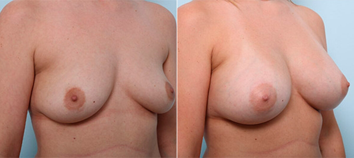 Breast Augmentation before and after photos in Houston, TX, Patient 26438