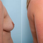 Breast Augmentation before and after photos in Houston, TX, Patient 26438