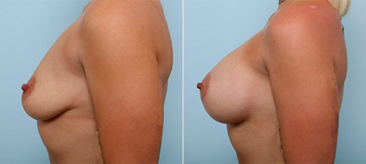 Breast Augmentation before and after photos in Houston, TX, Patient 26449