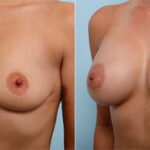 Breast Augmentation before and after photos in Houston, TX, Patient 26449