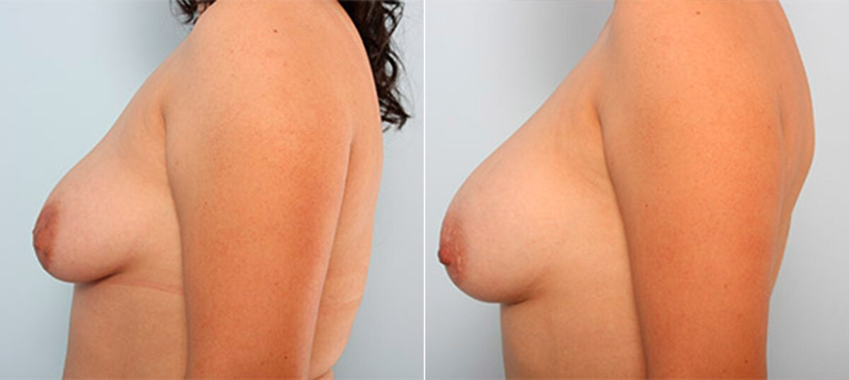 Breast Augmentation before and after photos in Houston, TX, Patient 26460