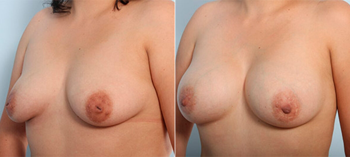 Breast Augmentation before and after photos in Houston, TX, Patient 26460