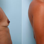Breast Augmentation before and after photos in Houston, TX, Patient 26472