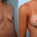 Breast Augmentation before and after photos in Houston, TX, Patient 26472