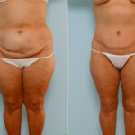 Body Lift before and after photos in Houston, TX, Patient 26914