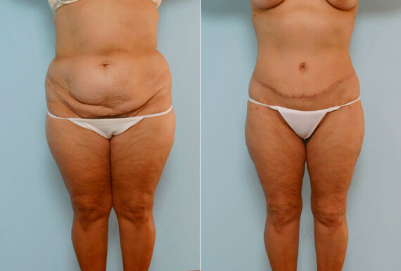 Body Lift before and after photos in Houston, TX, Patient 26914