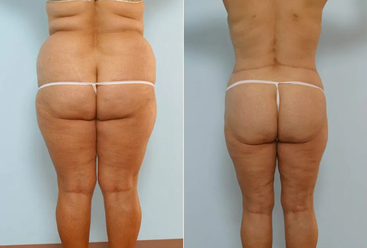 Body Lift before and after photos in Houston, TX, Patient 26914