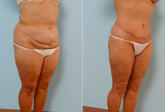 Body Lift before and after photos in Houston, TX, Patient 26914