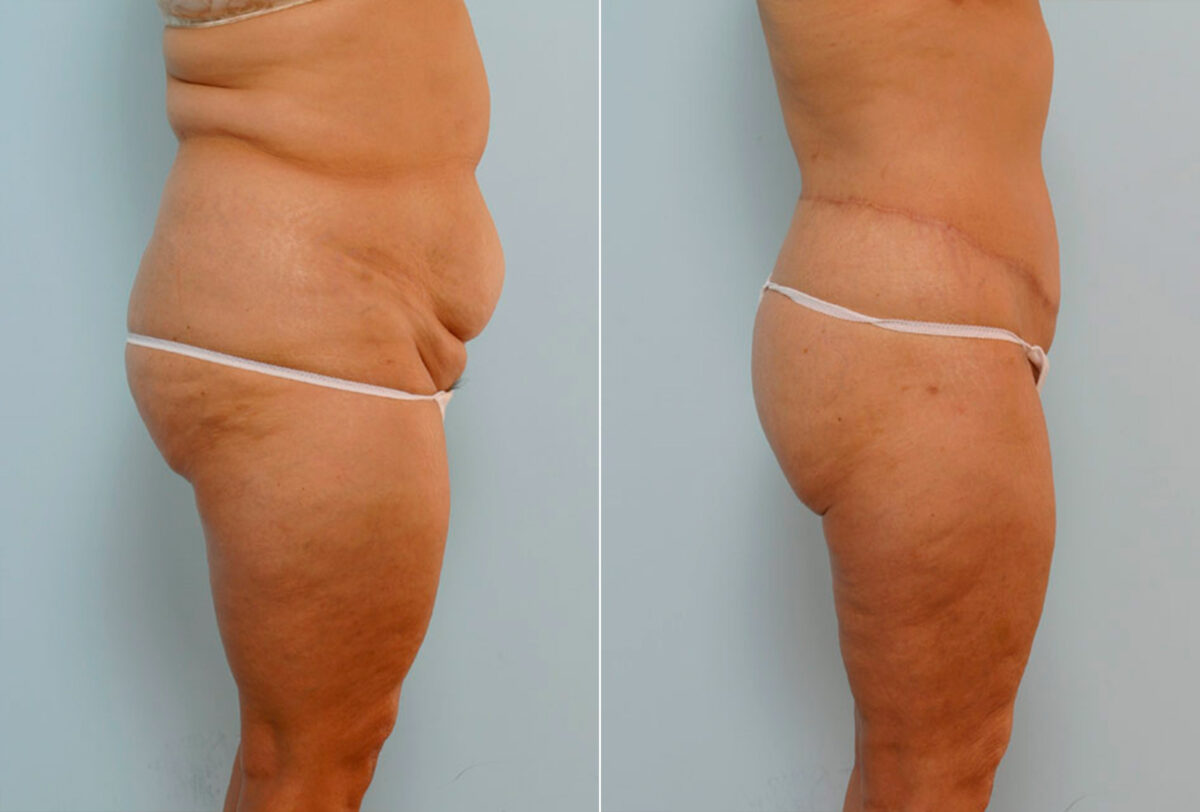 Body Lift before and after photos in Houston, TX, Patient 26914