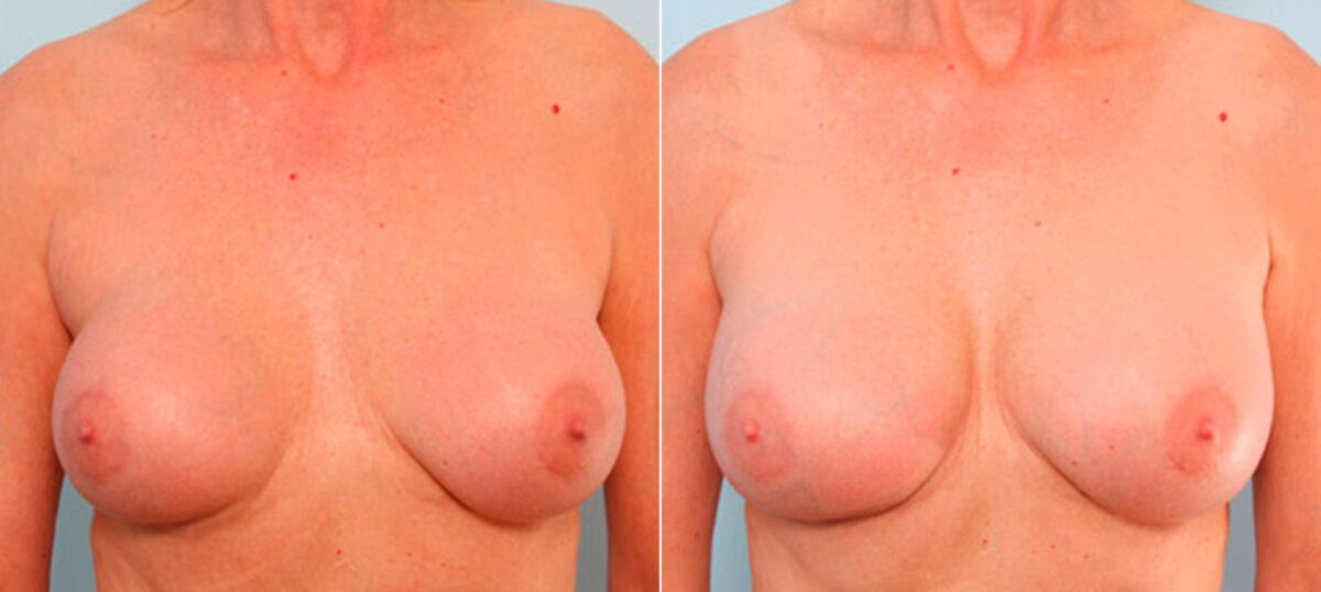 Breast Revision with Strattice before and after photos in Houston, TX, Patient 27147