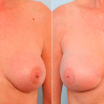 Breast Revision with Strattice before and after photos in Houston, TX, Patient 27147