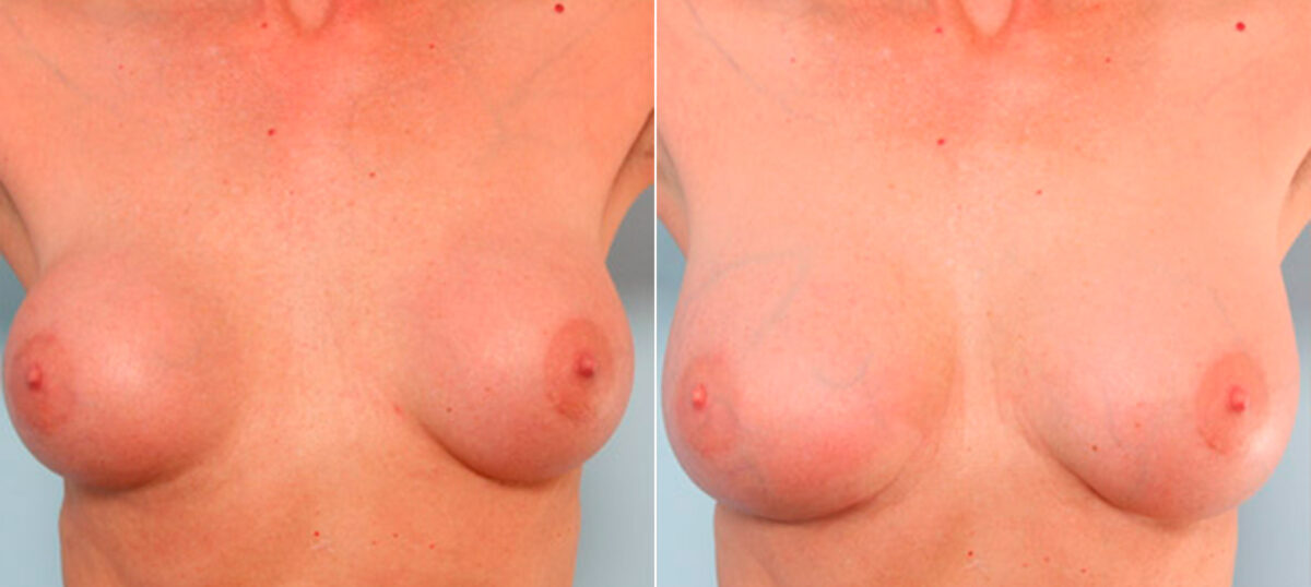 Breast Revision with Strattice before and after photos in Houston, TX, Patient 27147