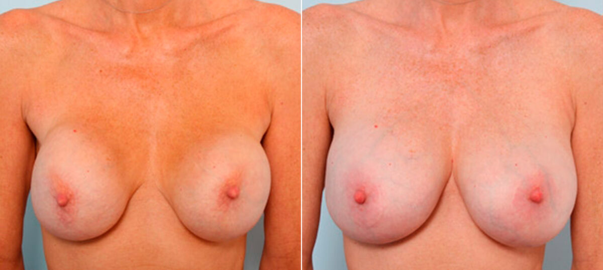 Breast Revision with Strattice before and after photos in Houston, TX, Patient 27152