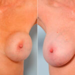 Breast Revision with Strattice before and after photos in Houston, TX, Patient 27152
