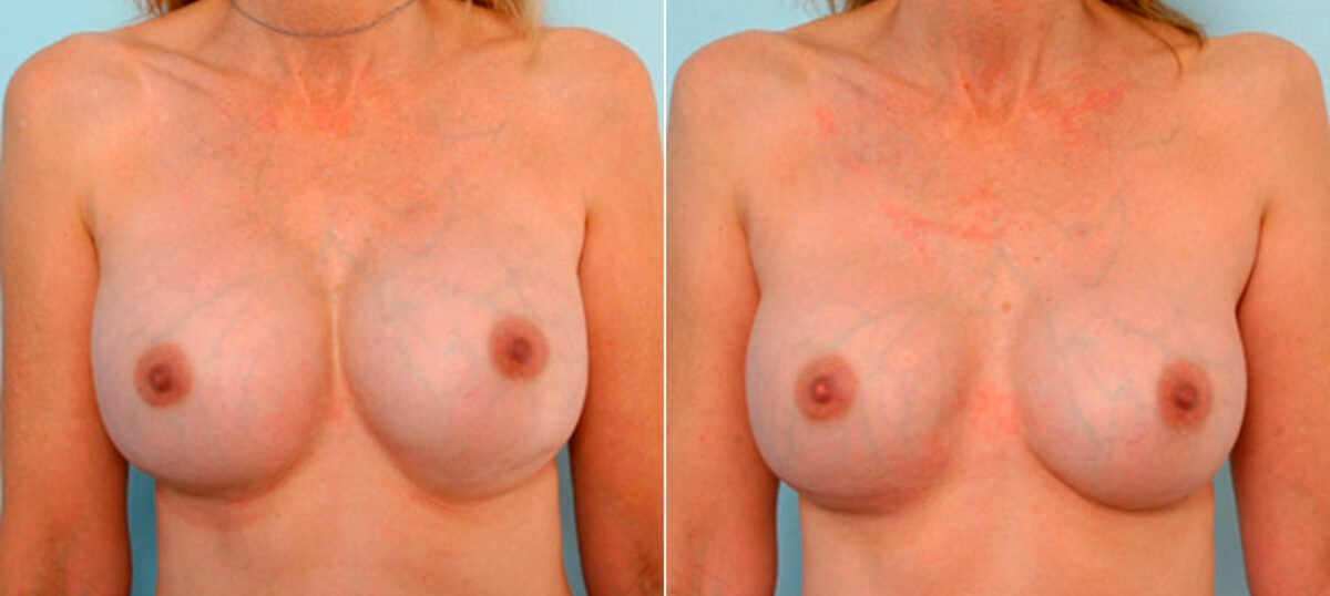 Breast Revision with Strattice before and after photos in Houston, TX, Patient 27159