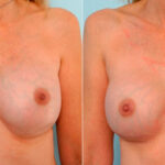 Breast Revision with Strattice before and after photos in Houston, TX, Patient 27159