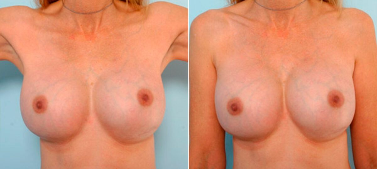 Breast Revision with Strattice before and after photos in Houston, TX, Patient 27159