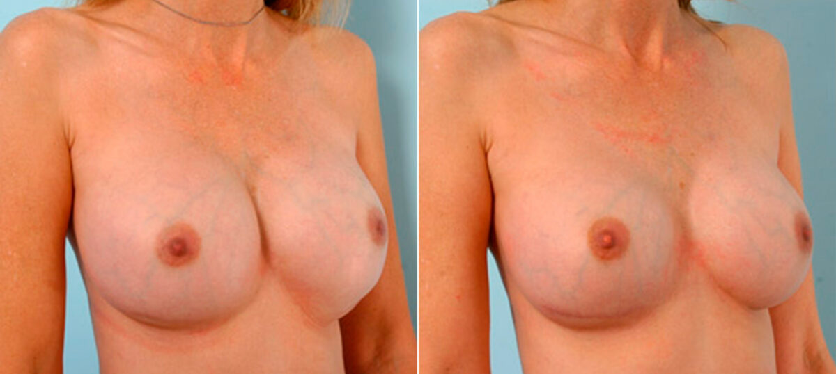 Breast Revision with Strattice before and after photos in Houston, TX, Patient 27159