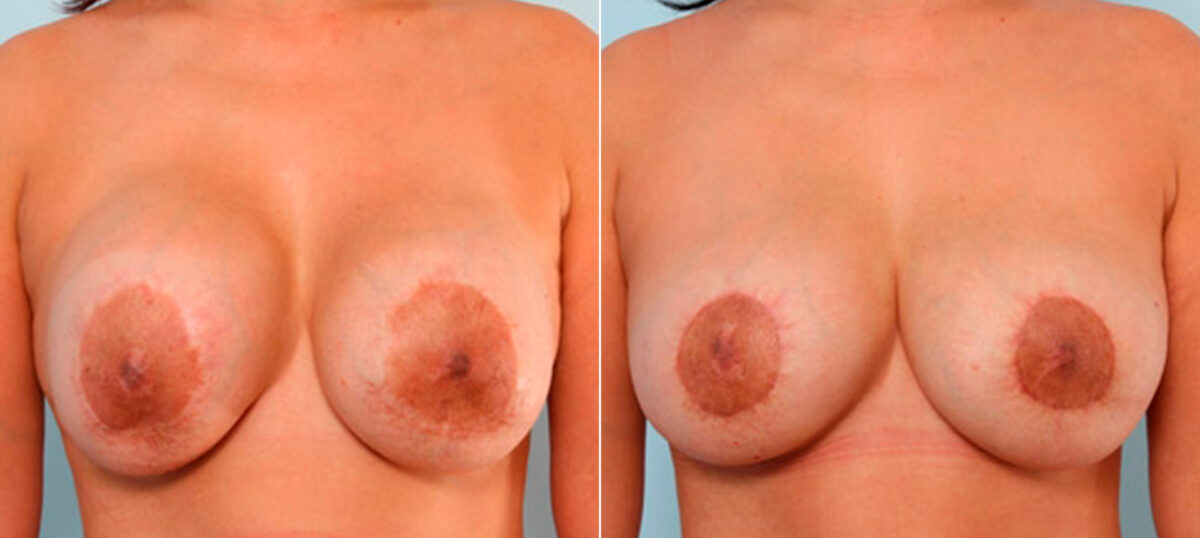 Breast Revision with Strattice before and after photos in Houston, TX, Patient 27166
