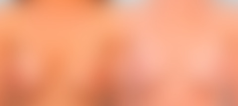 Breast Revision with Strattice before and after photos in Houston, TX, Patient 27173