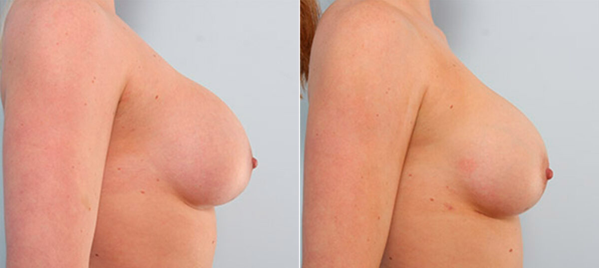 Breast Revision with Strattice before and after photos in Houston, TX, Patient 27180