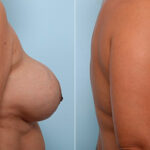 Breast Revision with Strattice before and after photos in Houston, TX, Patient 27191