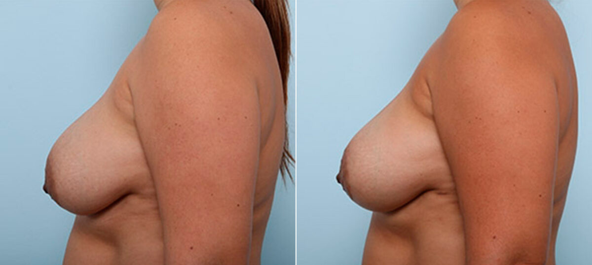 Breast Revision with Strattice before and after photos in Houston, TX, Patient 27191
