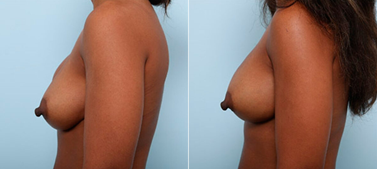 Breast Revision with Strattice before and after photos in Houston, TX, Patient 27202