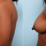 Breast Revision with Strattice before and after photos in Houston, TX, Patient 27202