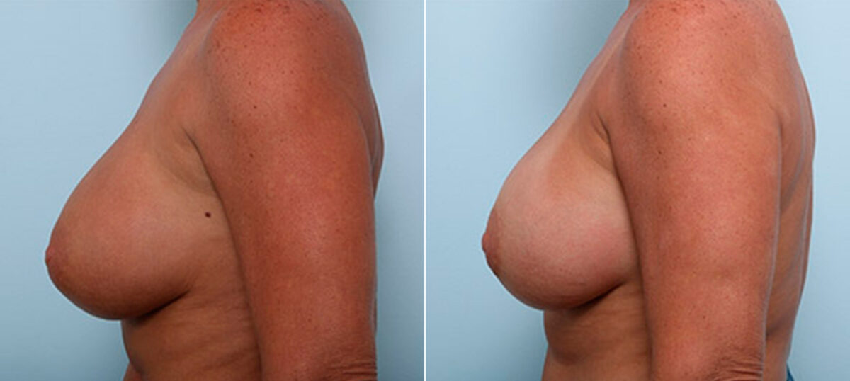 Breast Revision with Strattice before and after photos in Houston, TX, Patient 27213