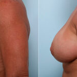 Breast Revision with Strattice before and after photos in Houston, TX, Patient 27213