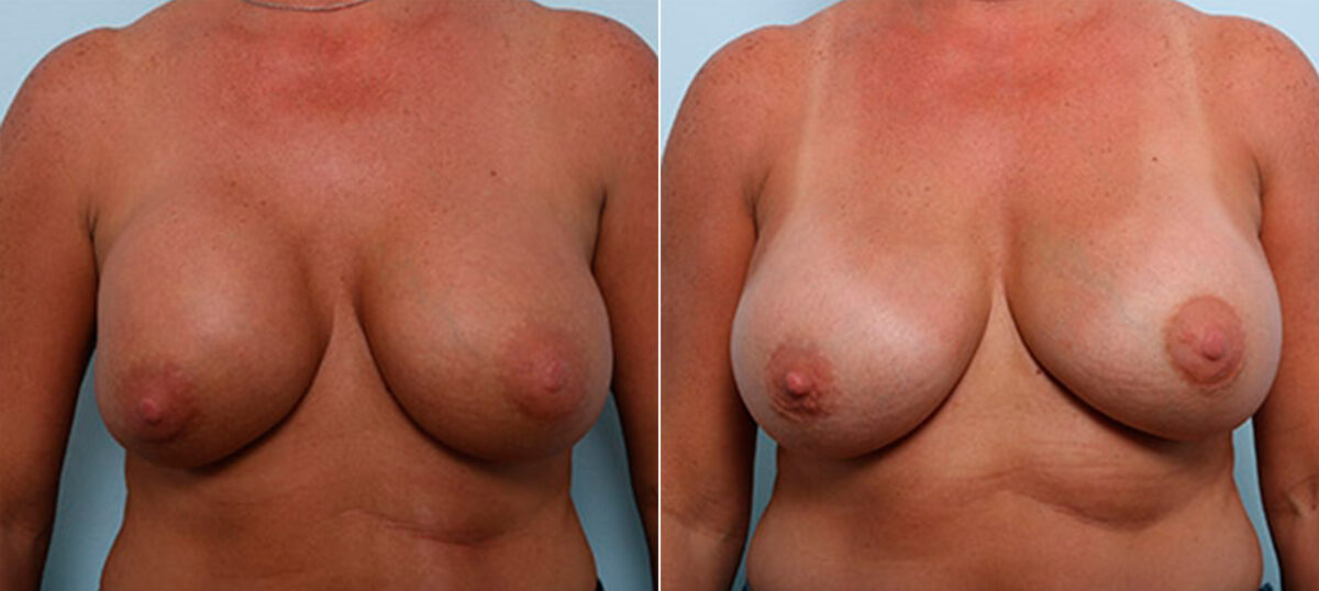 Breast Revision with Strattice before and after photos in Houston, TX, Patient 27213