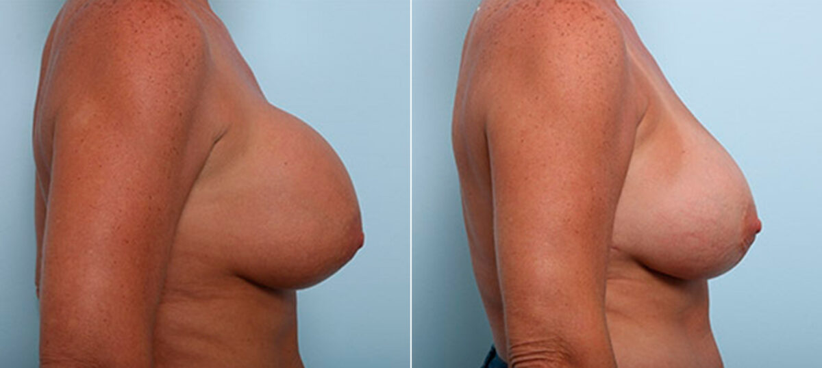 Breast Revision with Strattice before and after photos in Houston, TX, Patient 27213