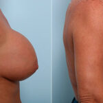 Breast Revision with Strattice before and after photos in Houston, TX, Patient 27213