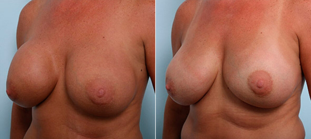 Breast Revision with Strattice before and after photos in Houston, TX, Patient 27213