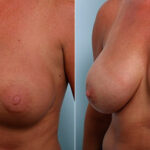 Breast Revision with Strattice before and after photos in Houston, TX, Patient 27213