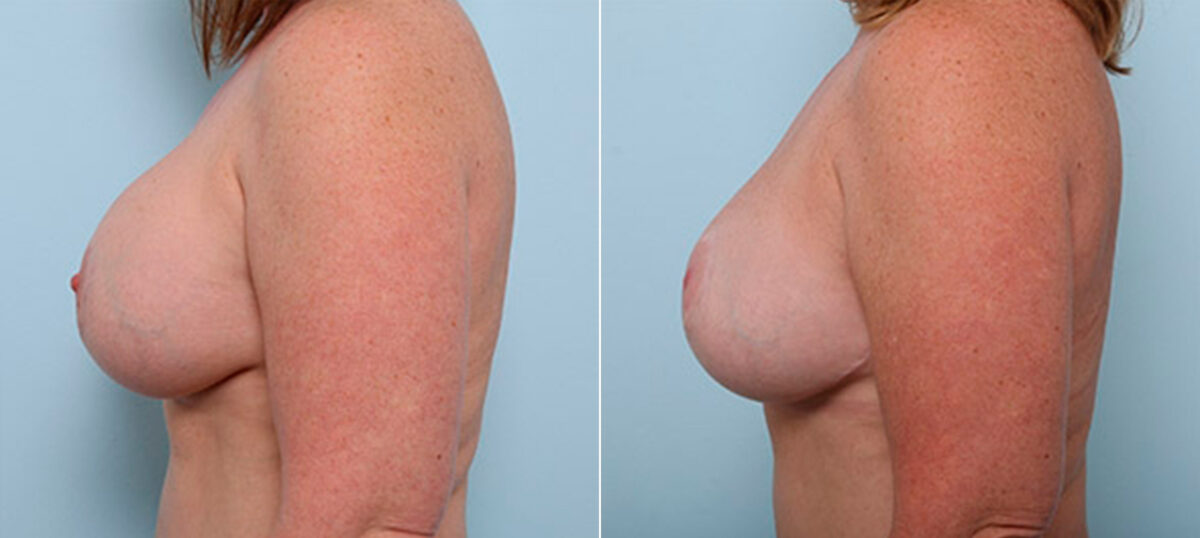 Breast Revision with Strattice before and after photos in Houston, TX, Patient 27224