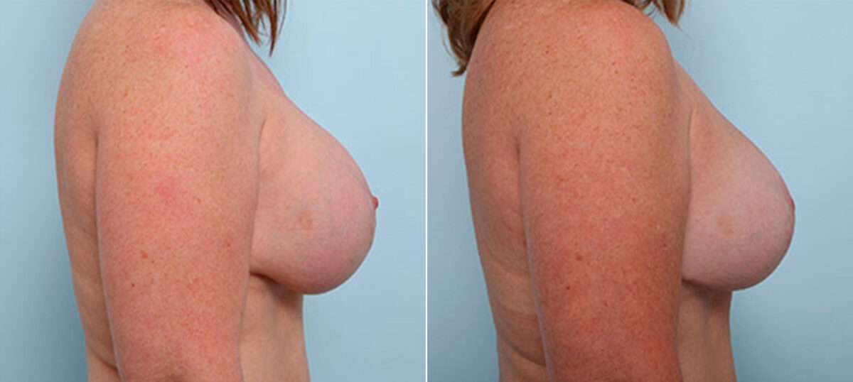 Breast Revision with Strattice before and after photos in Houston, TX, Patient 27224