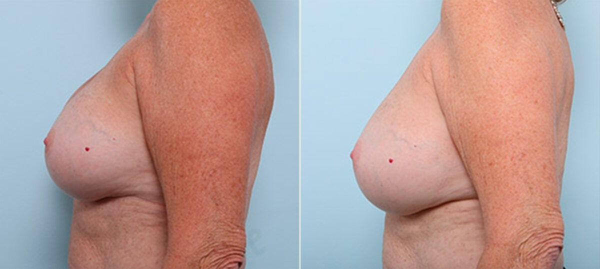 Breast Revision with Strattice before and after photos in Houston, TX, Patient 27235