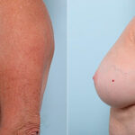 Breast Revision with Strattice before and after photos in Houston, TX, Patient 27235