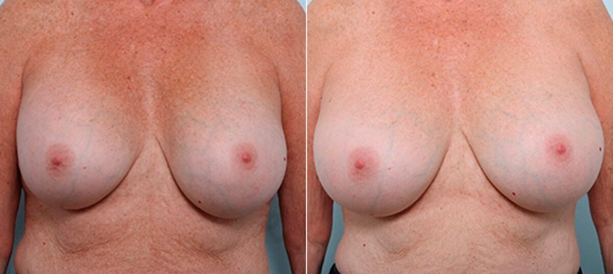 Breast Revision with Strattice before and after photos in Houston, TX, Patient 27235